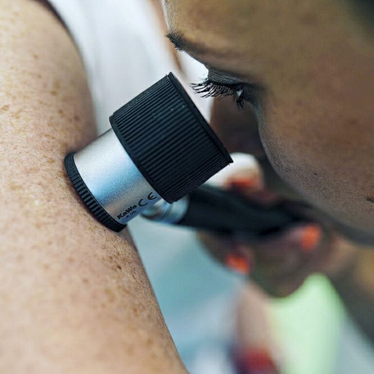 С помощью дерматоскопии доктор определит новообразование на коже